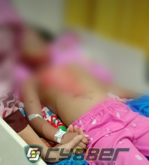 Malang Nasib Amelia Nuraini Yang Tersiram Air Panas