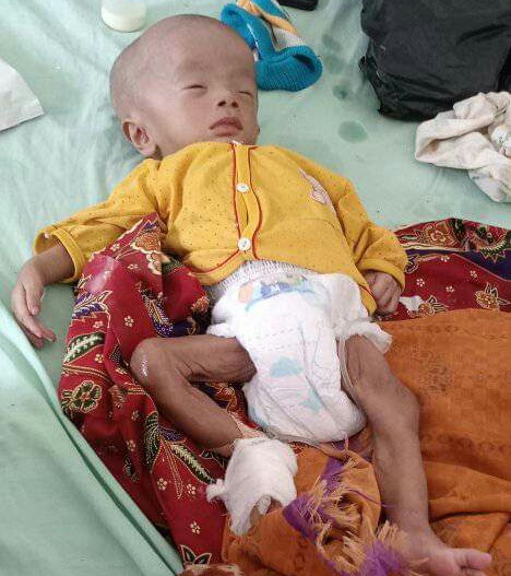 Diduga Kades dan Dinkes Parimo Gagal Beri Perlindungan Pada Aidan Bayi Penderita Gizi Buruk Yang Meninggal Dunia 