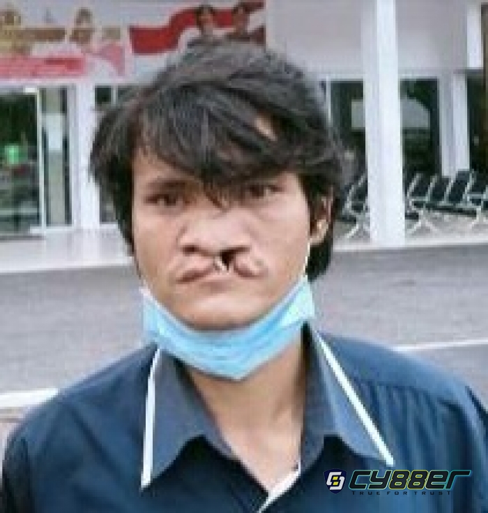 Hari Bhayangkara ke 76, Polsek Tualang Bantu Seorang Warga Operasi Bibir Sumbing
