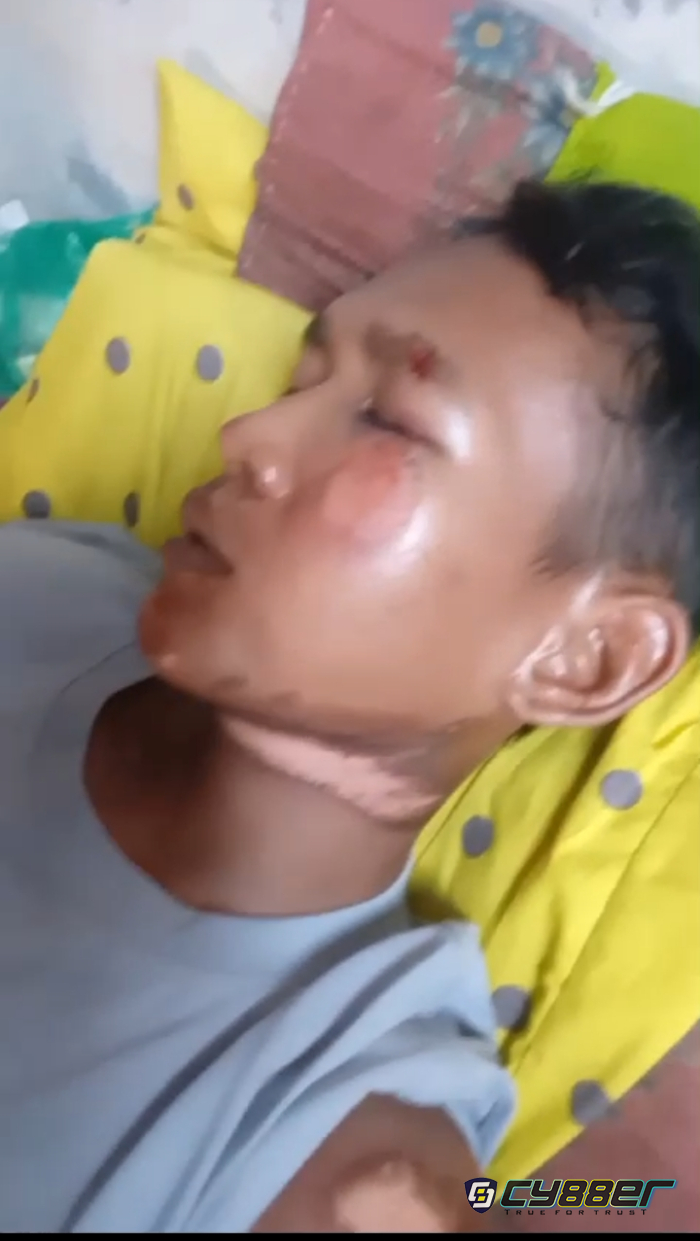 Warga Alij Jaya Jadi  Korban Keteledoran PLN, Terluka Akibat Kabel Listrik