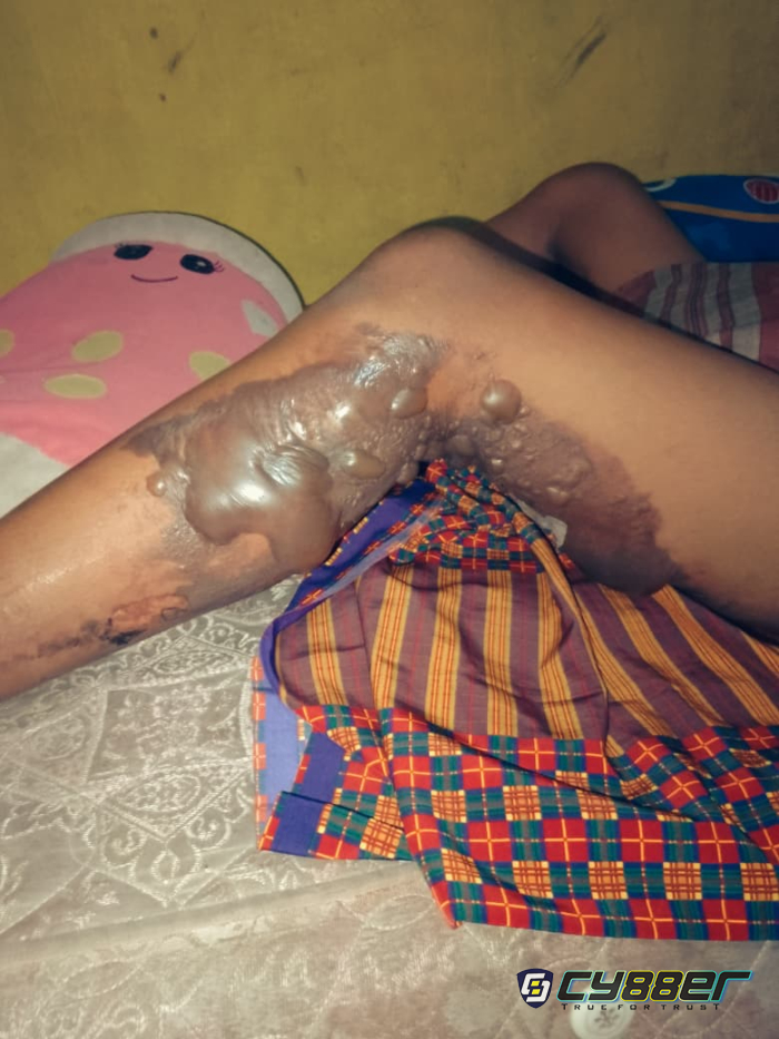 Anak di Cilegon Alami Luka Bakar Diduga Akibat Molotov