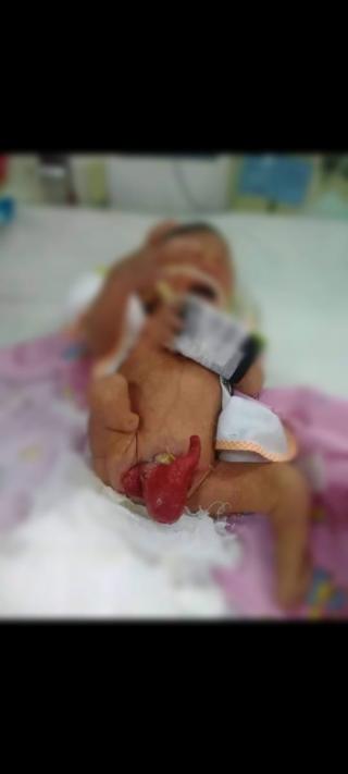 Bayi Penderita Penyakit Kompleks Butuh Uluran Tangan