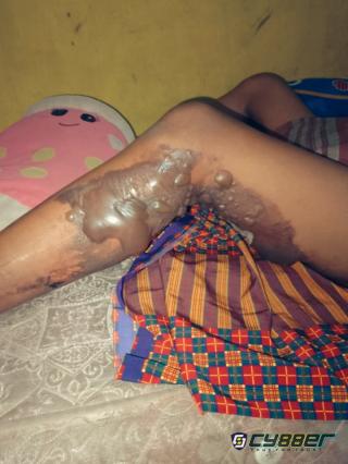 Anak di Cilegon Alami Luka Bakar Diduga Akibat Molotov